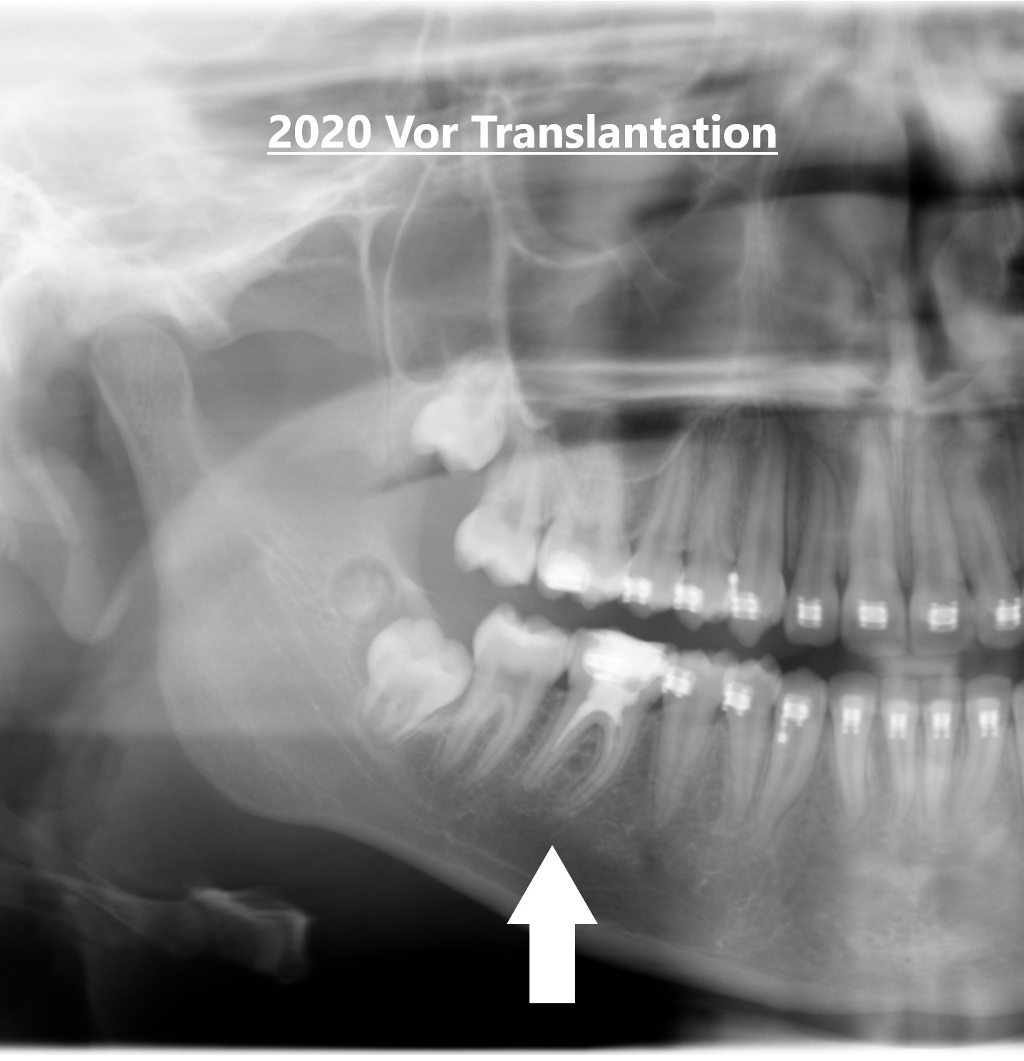 Erfolgreiche Weisheitszahn-Transplantation im Haus der Zahngesundheit Köln – kranker Backenzahn wurde durch eigenen Weisheitszahn ersetzt, vital und funktionell eingewachsen.