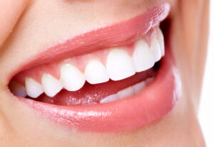natürlich schöne Frontzähne durch Veneers in Köln