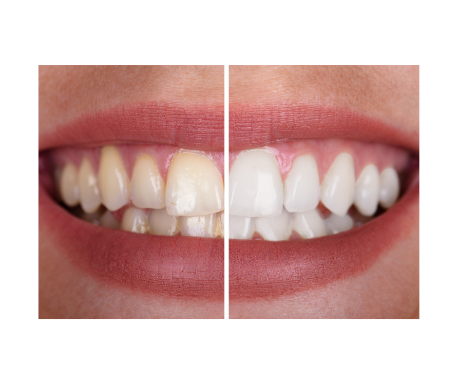 Vorher-nachher Vergleich nach professionellem Bleaching in der Zahnarztpraxis Haus der Zahngesundheit Köln – sichtbar weißere Zähne und natürliches Ergebnis