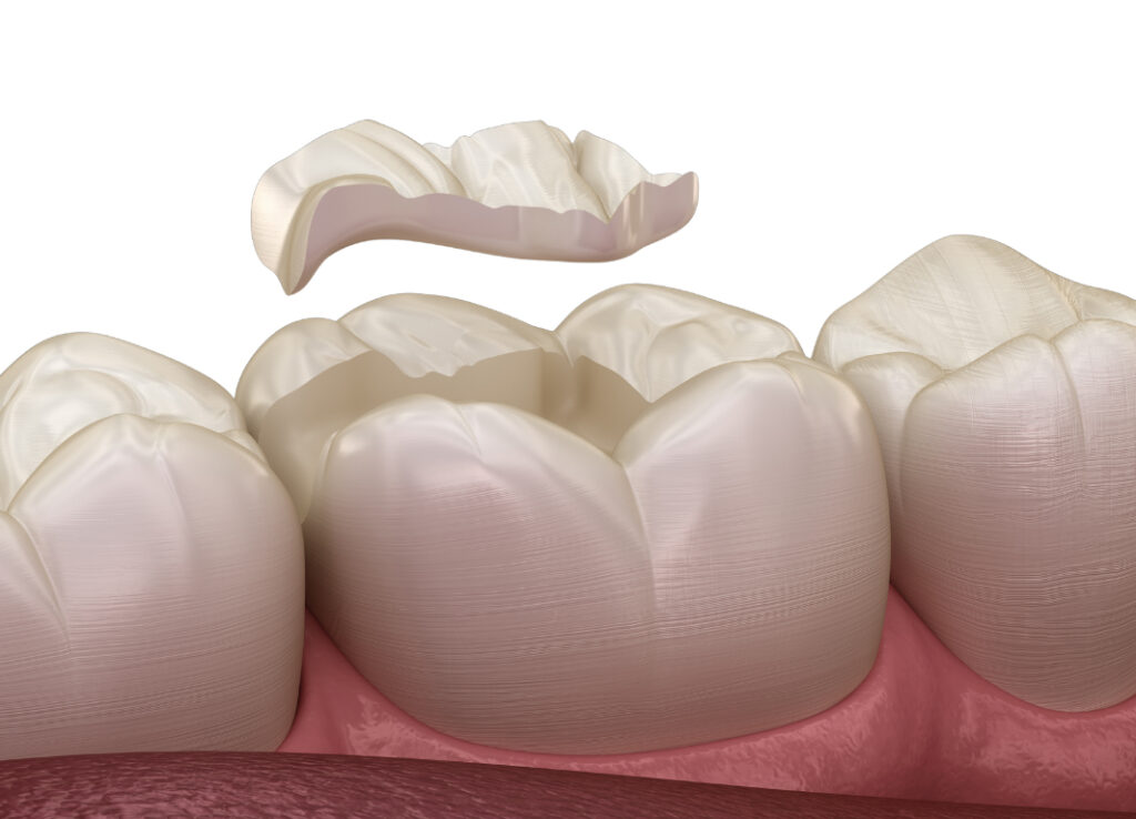 Grafik zur Erklärung eines Inlays im Zahn – Aufbau und Funktion anschaulich dargestellt