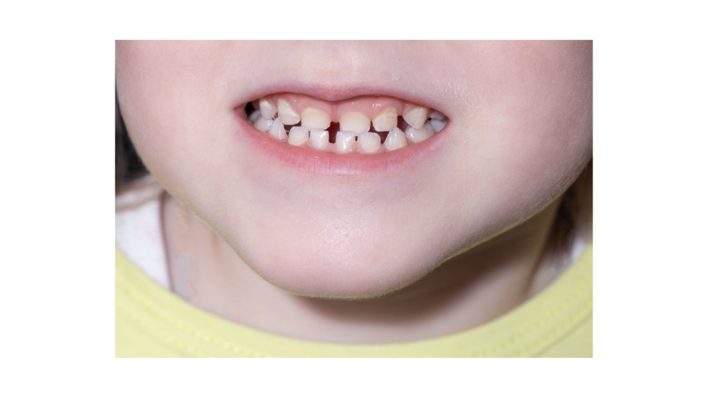 Ganzheitliche Kieferorthopädie Kinder Frühbehandlung