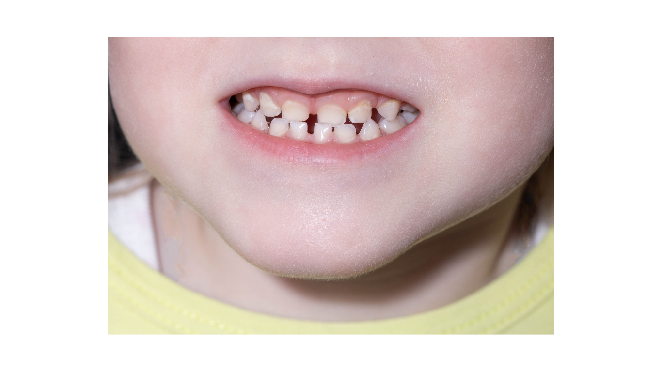 Ganzheitliche Kieferorthopädie Kinder Frühbehandlung